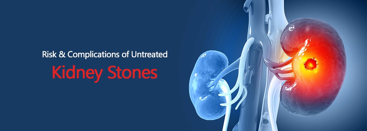 Stone risks & failure—Complications: Risk of kidney failure - Dr Zubair ...